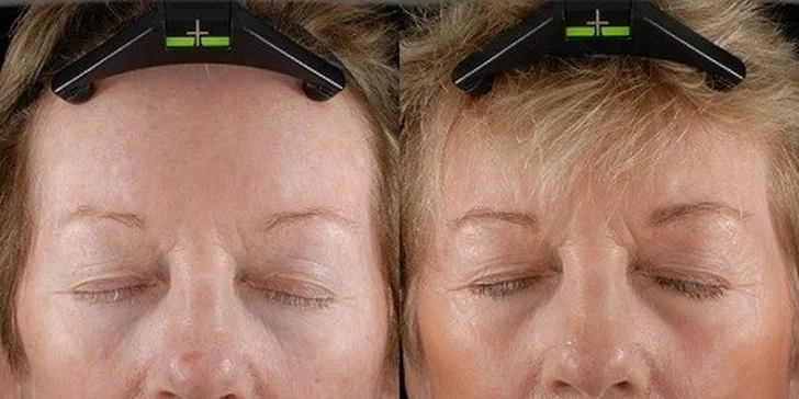Novinka v estetickej medicíne Frakčný resurfacing