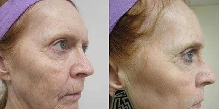 Novinka v estetickej medicíne Frakčný resurfacing
