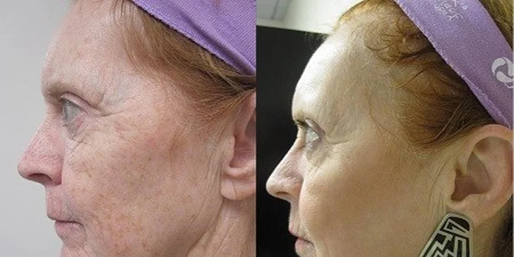 Novinka v estetickej medicíne Frakčný resurfacing
