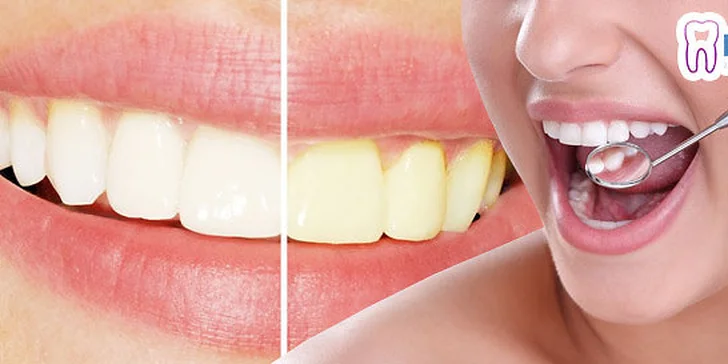 Dentálna hygiena, pieskovanie alebo profesionálne bielenie