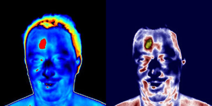 Termografická diagnostika tela s analýzou výsledkov lekárom a s terapiou
