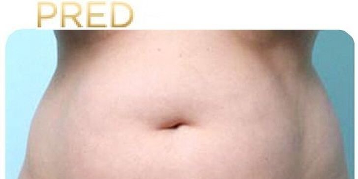 Najúčinnejšia moderná liposukcia - SlimLipo