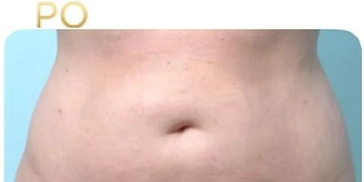 Najúčinnejšia moderná liposukcia - SlimLipo
