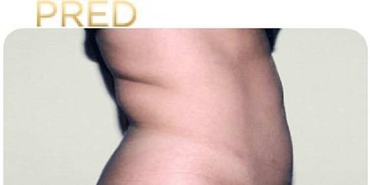 Najúčinnejšia moderná liposukcia - SlimLipo