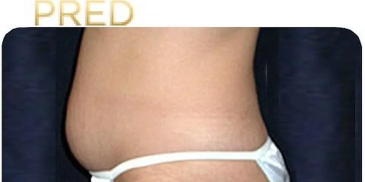 Najúčinnejšia moderná liposukcia - SlimLipo