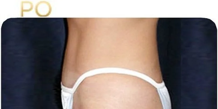 Najúčinnejšia moderná liposukcia - SlimLipo
