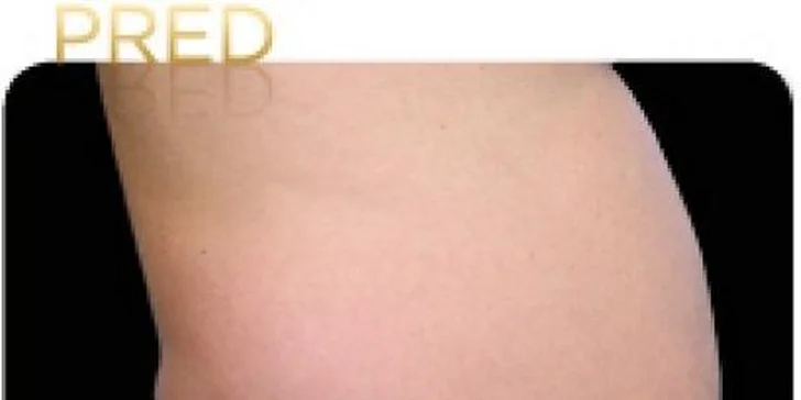Najúčinnejšia moderná liposukcia - SlimLipo