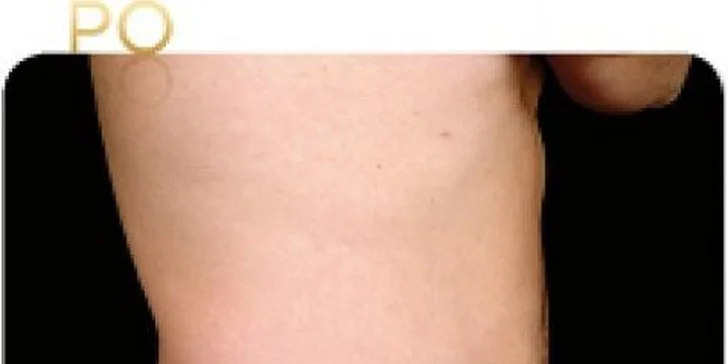 Najúčinnejšia moderná liposukcia - SlimLipo